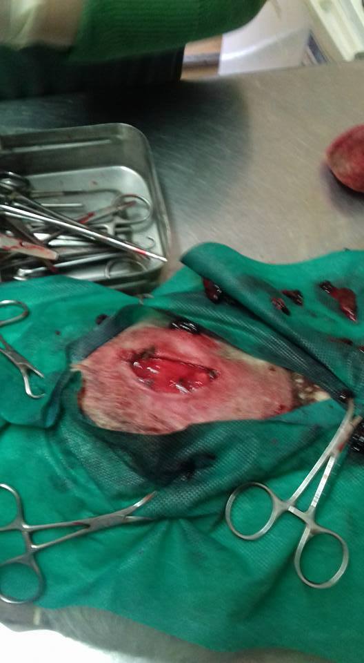 Cazul Toaca hernie inghinală hematom hemitoracele drept